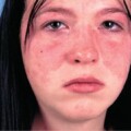 Mortalidad por lupus eritematoso sistémico…